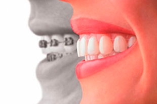 Ortodontia acelerada